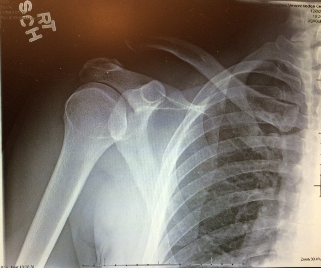 Type 5 Separated Shoulder X-ray