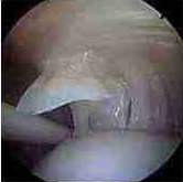  Rotator cuff partial tear 